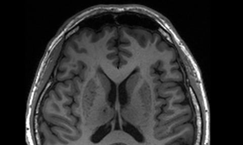 MRI image of a patient with enlarged perivascular spaces